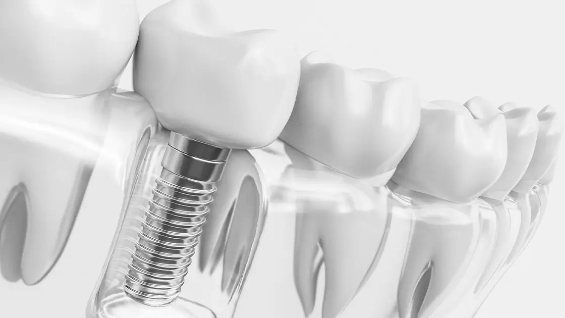 dental implant